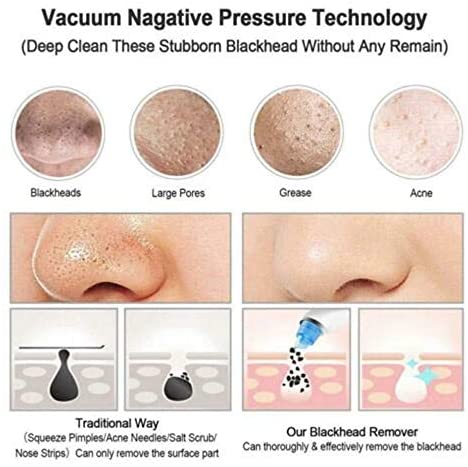 Blackhead Remover Only For Ladies